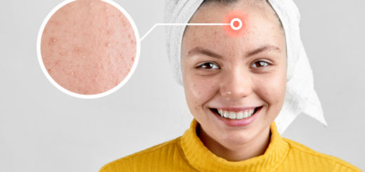 Remedios caseros para tratar el acné juvenil